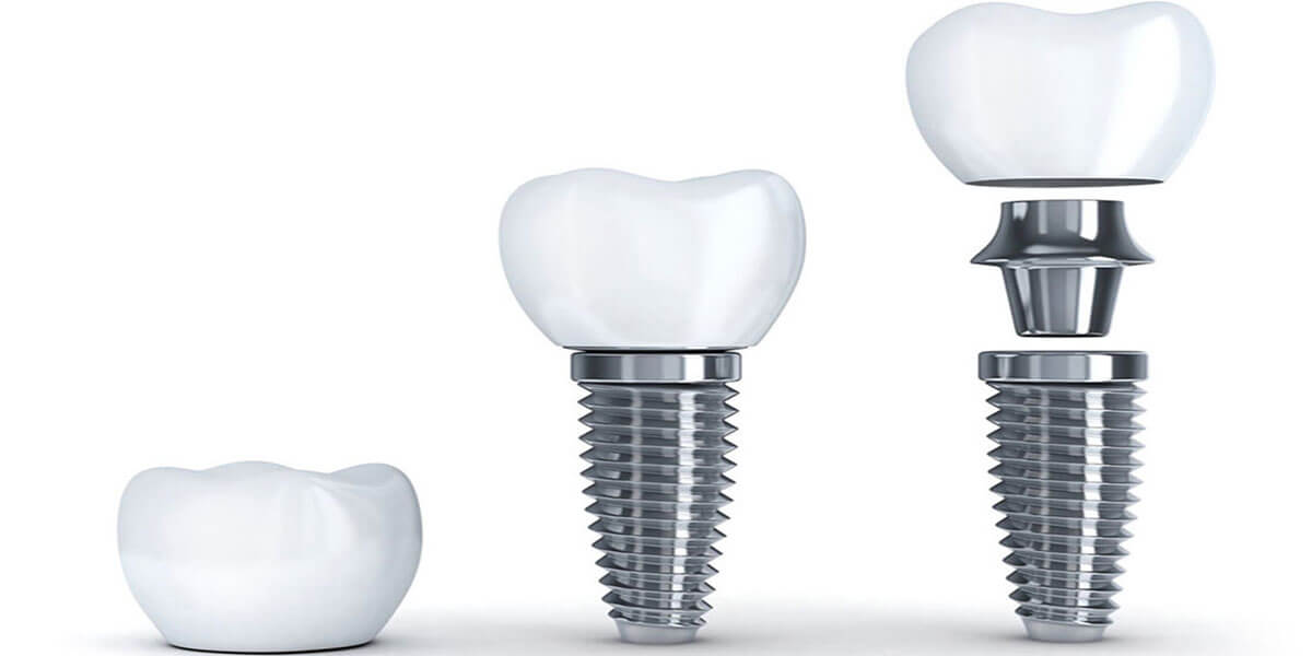 Dental implants myths600 2018.jpg