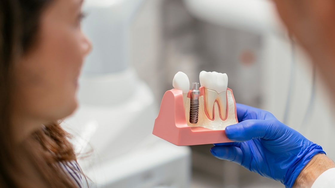 Dental implant model photo