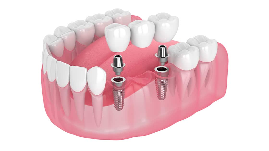 Dental Supported Bridges Image