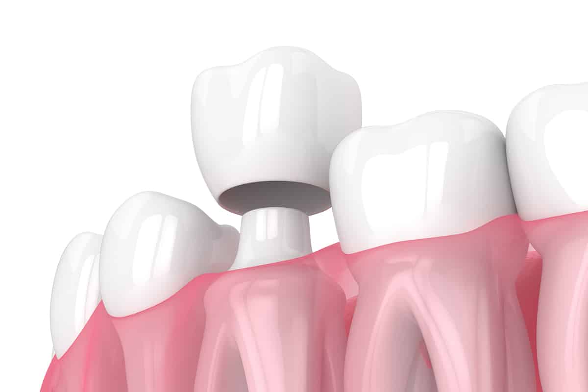 How much does a dental crown cost materials lab fees and treatment options blog