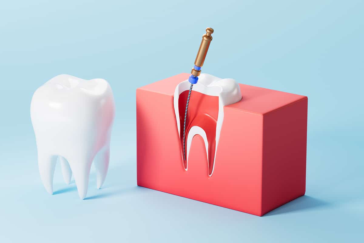 How much does a root canal cost price breakdown by tooth type blog