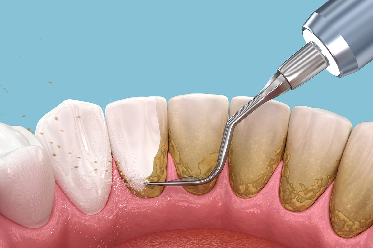 How painful is scaling and root planing pain recovery and what to expect blog