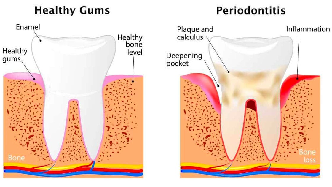 Periodontal Stages of Disease Graphic