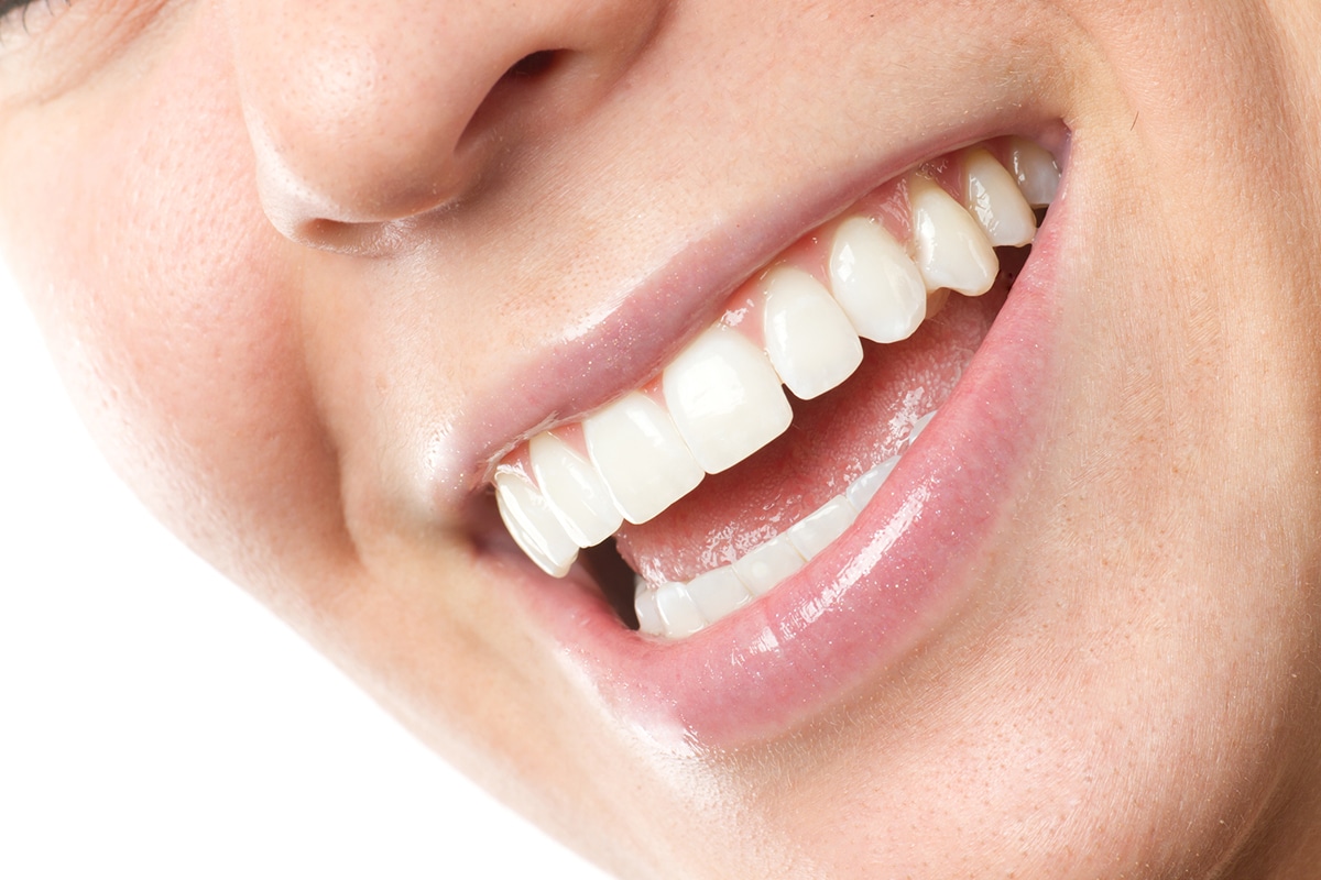 Porcelain veneers vs composite veneers pros cons and costs blog