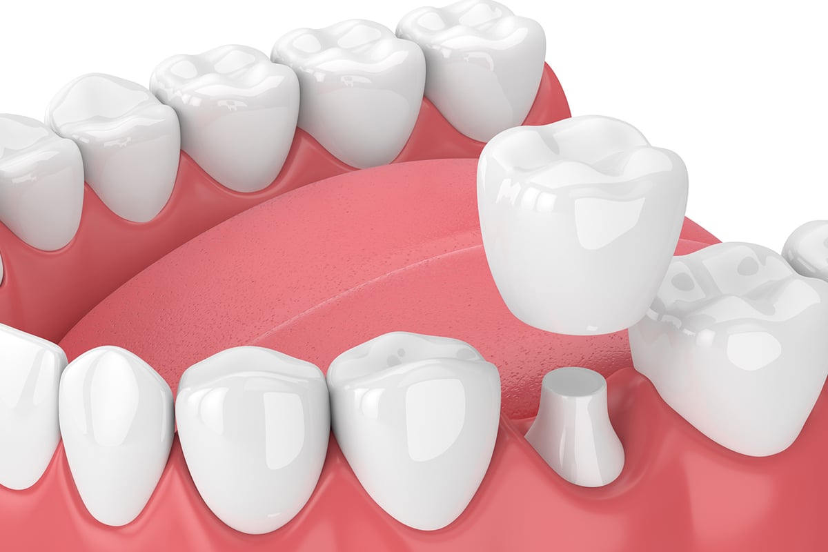 Same day crowns vs traditional crowns time cost and durability blog